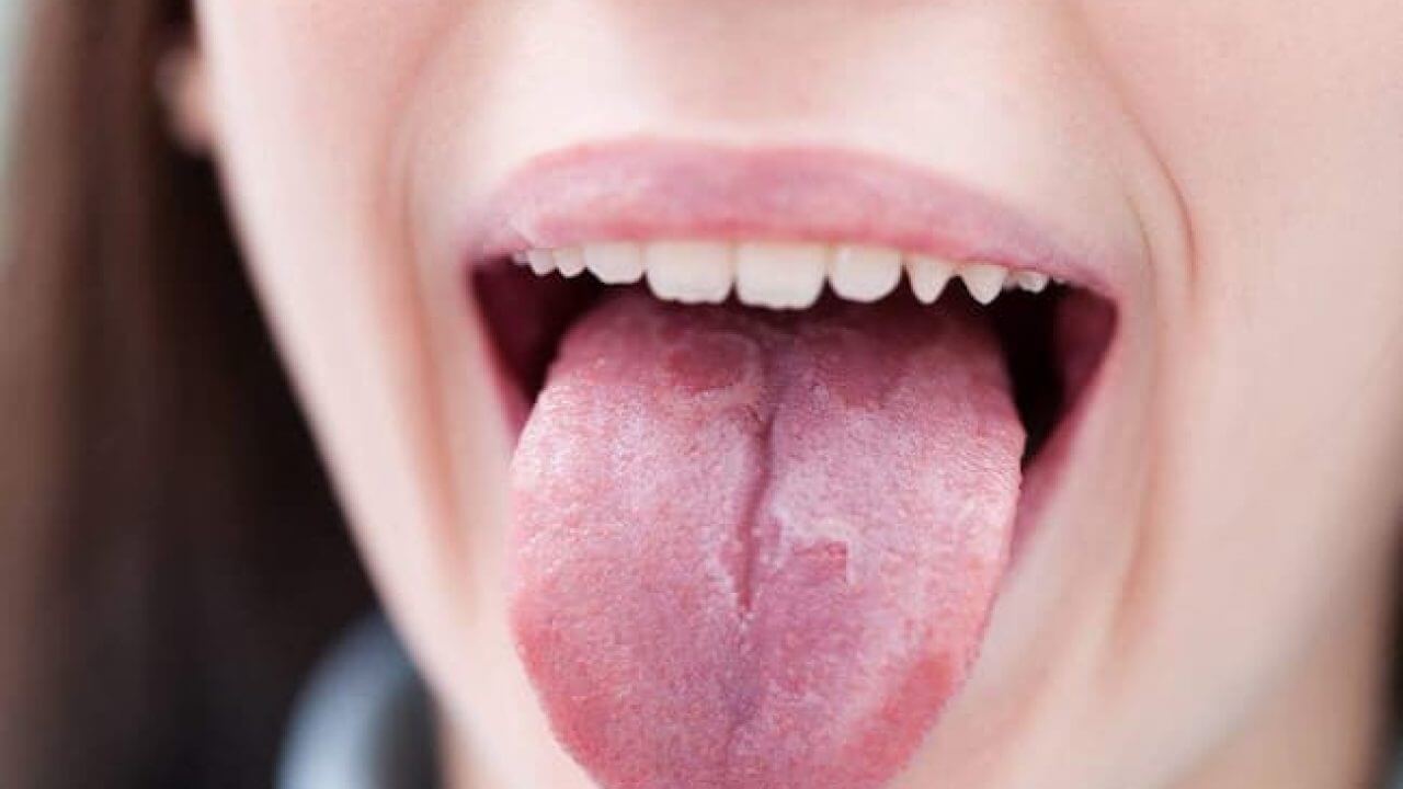 Yanan Ağız Sendromu - Burning Mouth Syndrome Homeopati Tedavisi